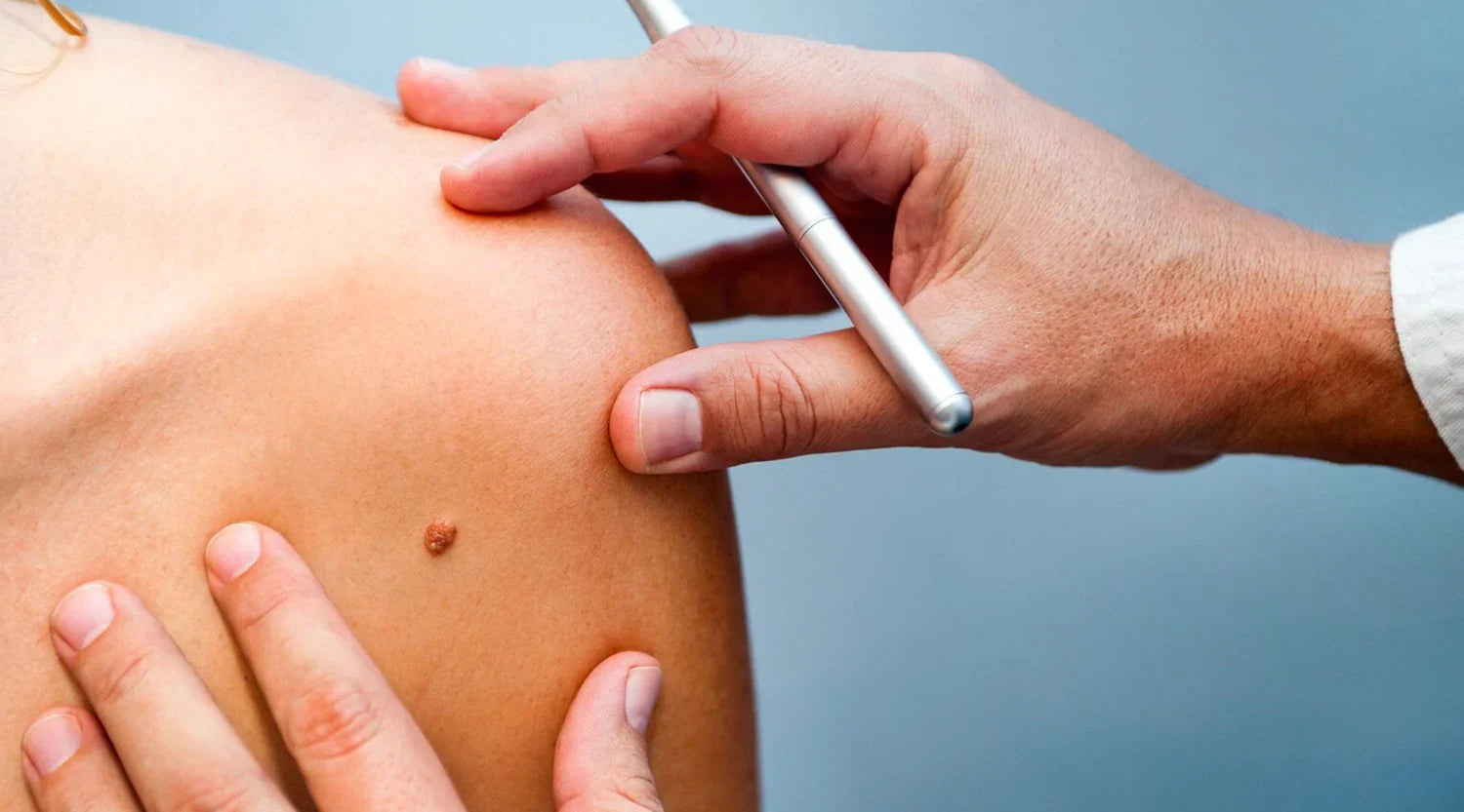 The ABCDE of Skin Checking | Skin Health Guide | Aurelia Sun