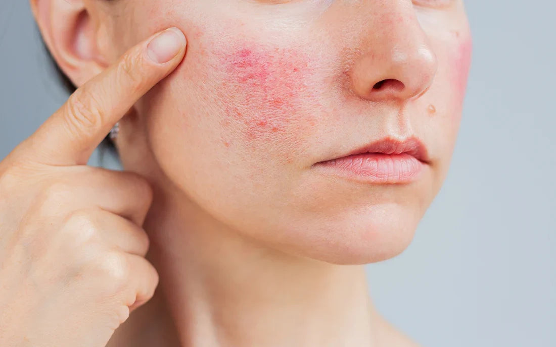 Rosacea and Sun Exposure: How to Protect Sensitive Skin and Reduce Flare-Up Triggers